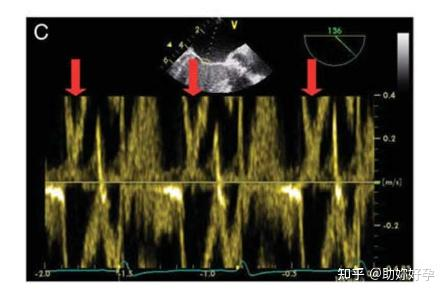 超声成像中的分辨率