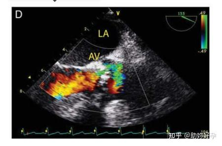 超声成像中的分辨率