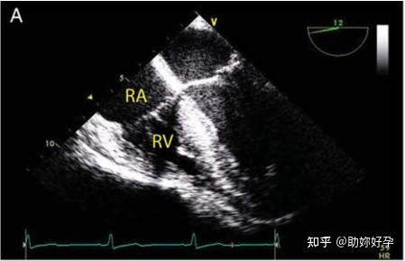 超声成像中的分辨率