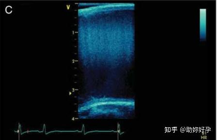 超声成像中的分辨率