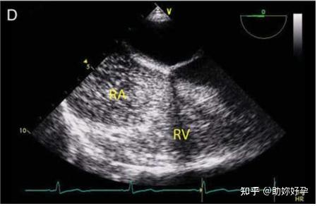 超声成像中的分辨率